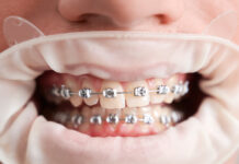 ბრეკეტების ფასები, ტიპები და ორთოდონტის რჩევები