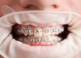 ბრეკეტების ფასები, ტიპები და ორთოდონტის რჩევები